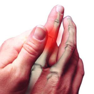 Arthrite des doigts: traitement, causes, symptômes