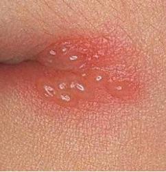 Comment guérir rapidement l'herpès sur les lèvres avec des médicaments de chimiothérapie et des remèdes populaires?